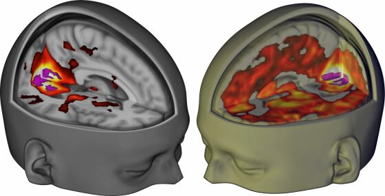 Hersenscans voor en na het nemen van LSD