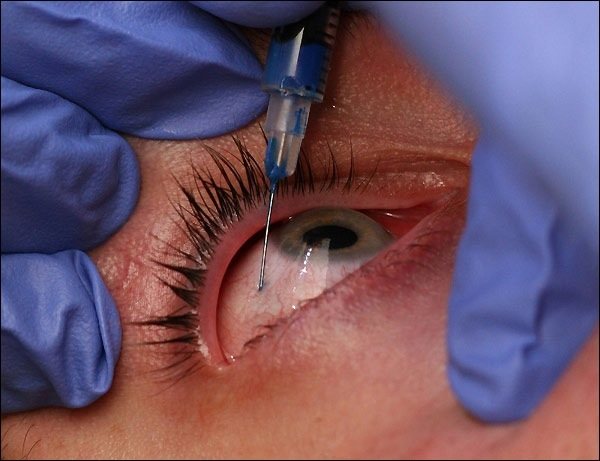 Las inyecciones deben ser practicadas por alguien que sepa lo que hace para no perder la vista