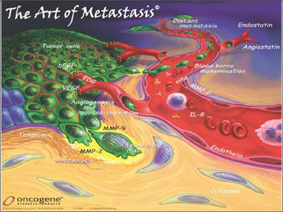 La metástasis es la expansión mortal de las células cancerosas por todo el cuerpo