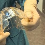 El implante colocado está creado con material plástico biocompatible
